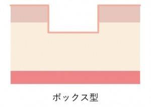 ニキビ跡図_ボックス