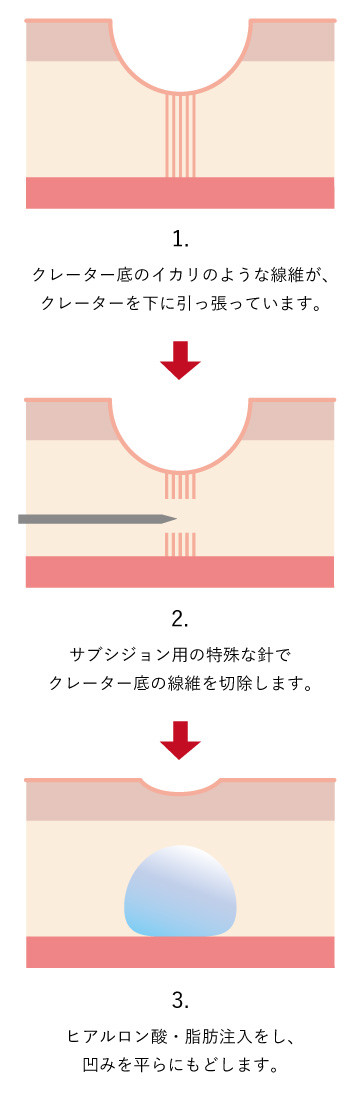 サブシジョン治療-説明図